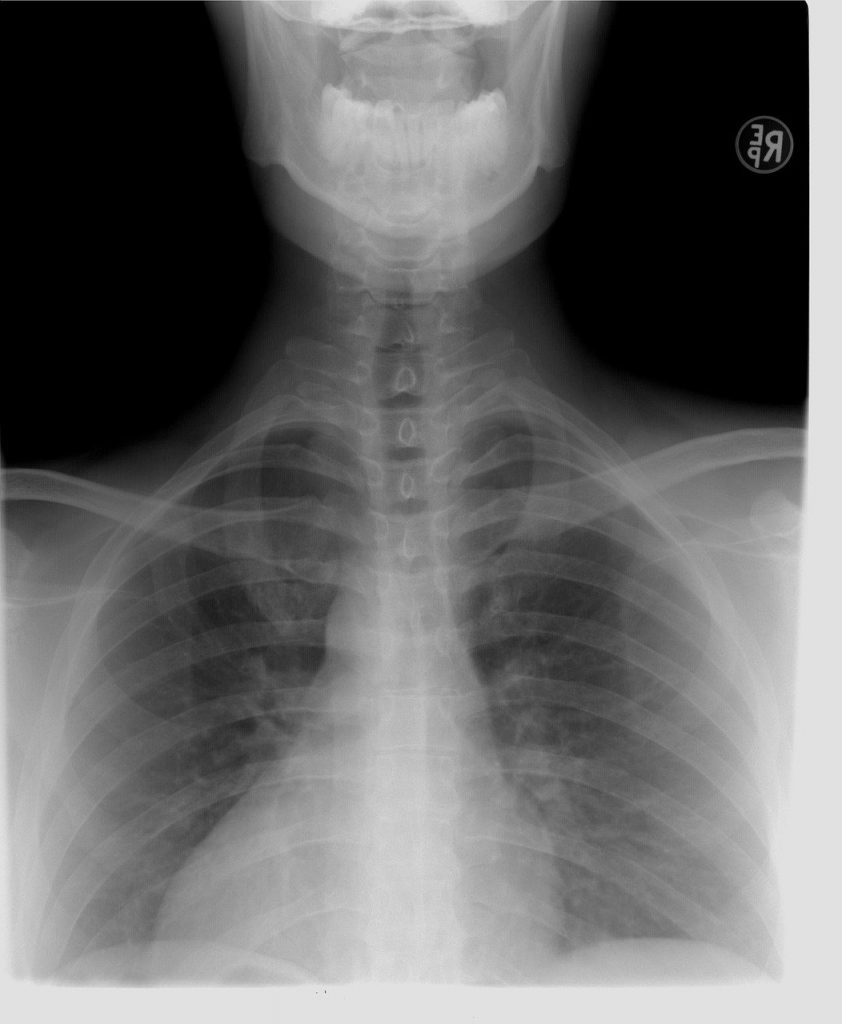 Spine Xray